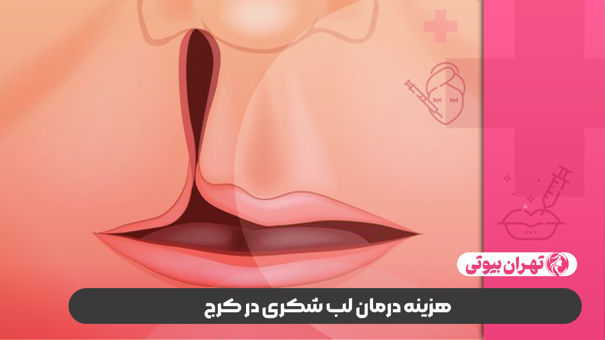 10 بهترین دکتر درمان لب شکری در کرج (شکاف کام و لب)