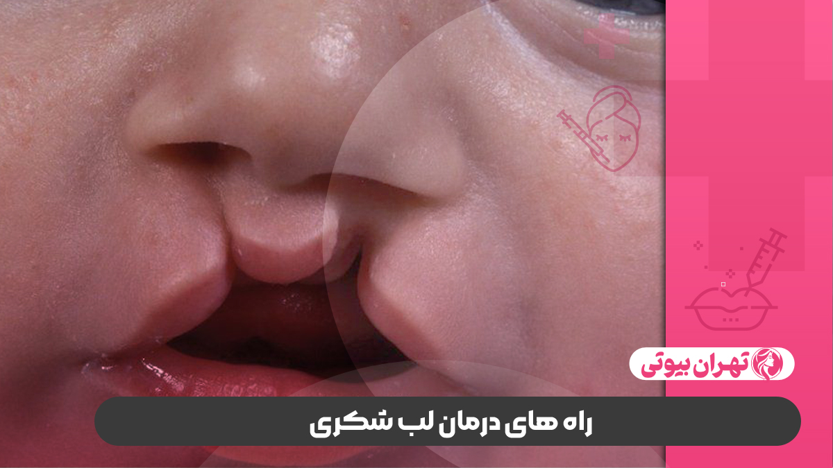 10 بهترین دکتر درمان لب شکری در کرج (شکاف کام و لب)