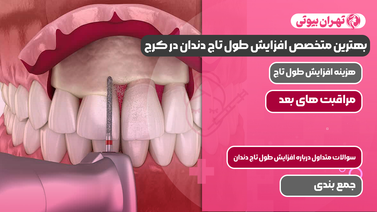10 بهترین متخصص افزایش طول تاج دندان در کرج