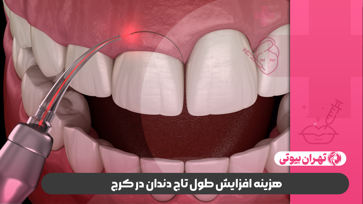10 بهترین متخصص افزایش طول تاج دندان در کرج