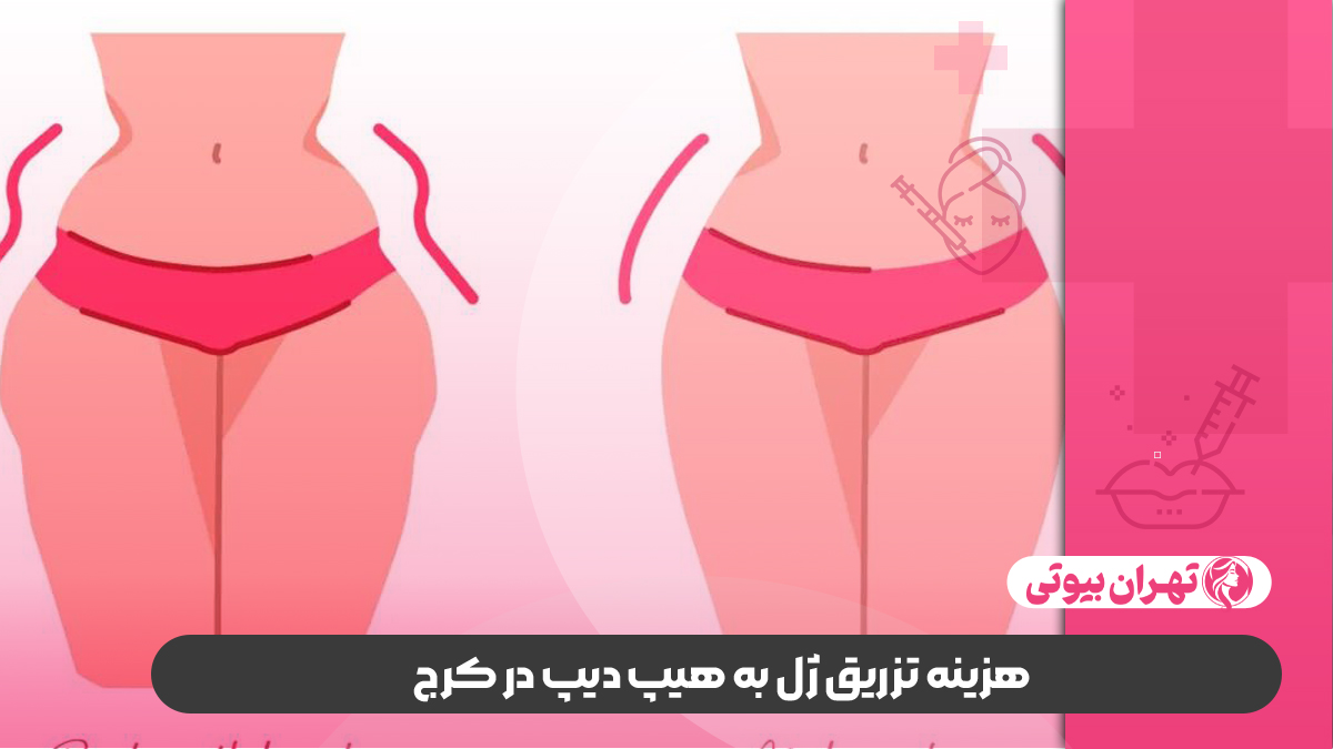 10 بهترین دکتر تزریق ژل به هیپ دیپ در کرج