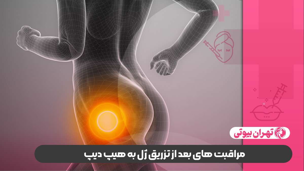 10 بهترین دکتر تزریق ژل به هیپ دیپ در کرج