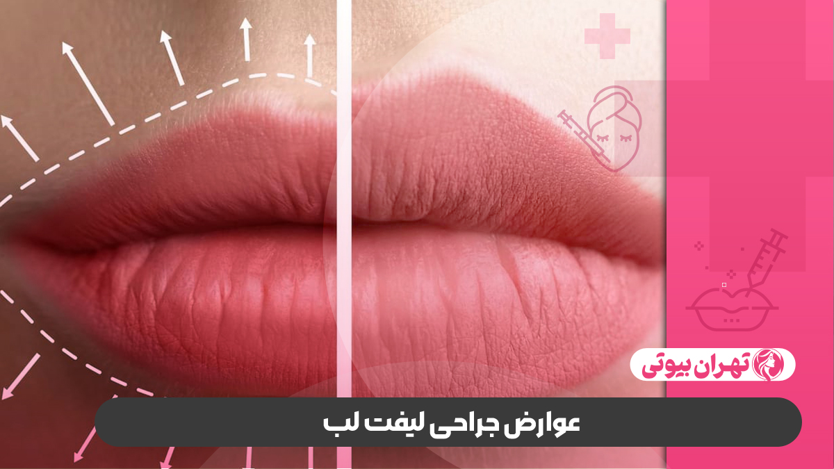 10 بهترین دکتر لیفت لب در کرج