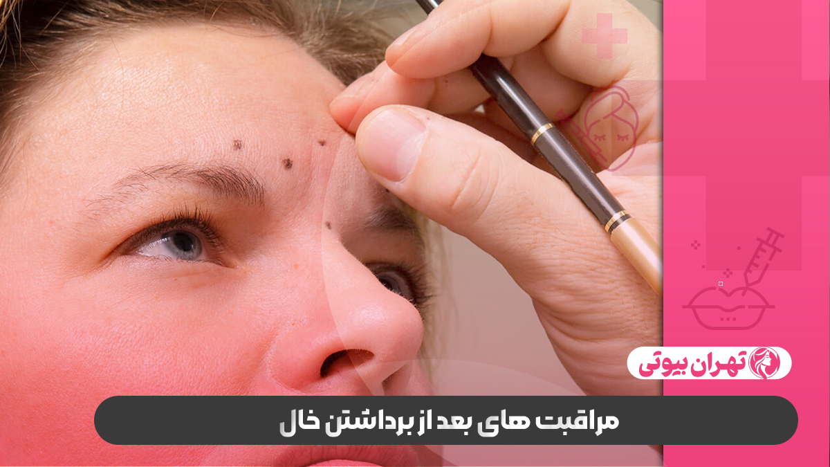 10 بهترین دکتر برداشتن خال در کرج
