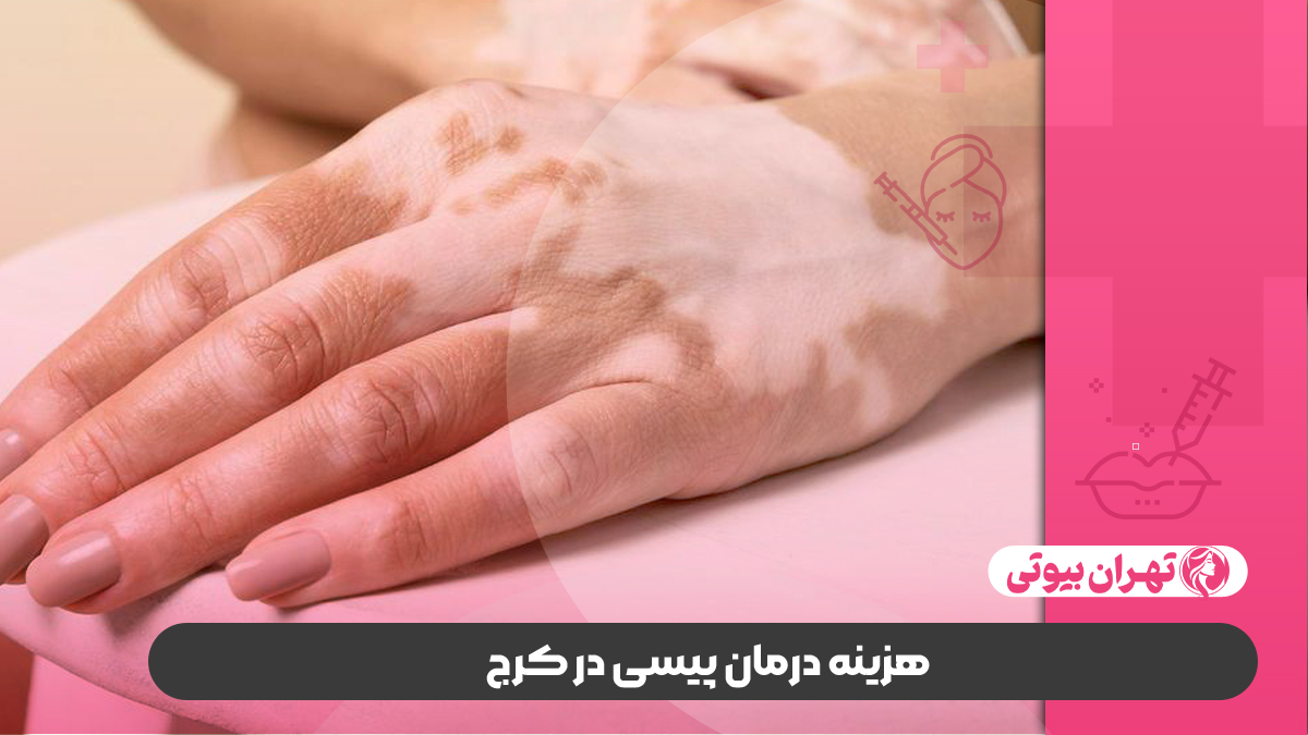 10 بهترین دکتر درمان قطعی پیسی در کرج (ویتیلیگو)