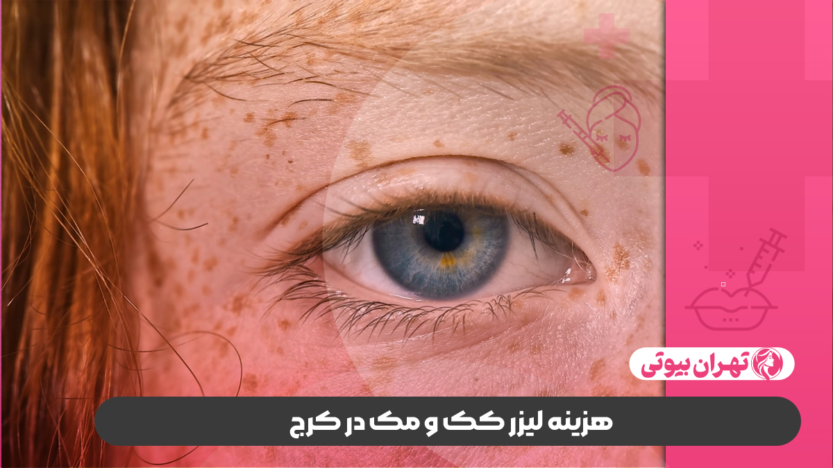 10 بهترین مرکز لیزر کک و مک در کرج