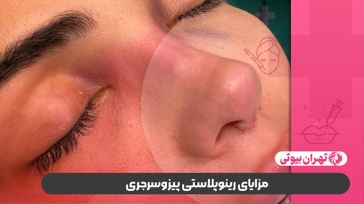 10 بهترین دکتر جراحی بینی با پیزوسرجری در کرج
