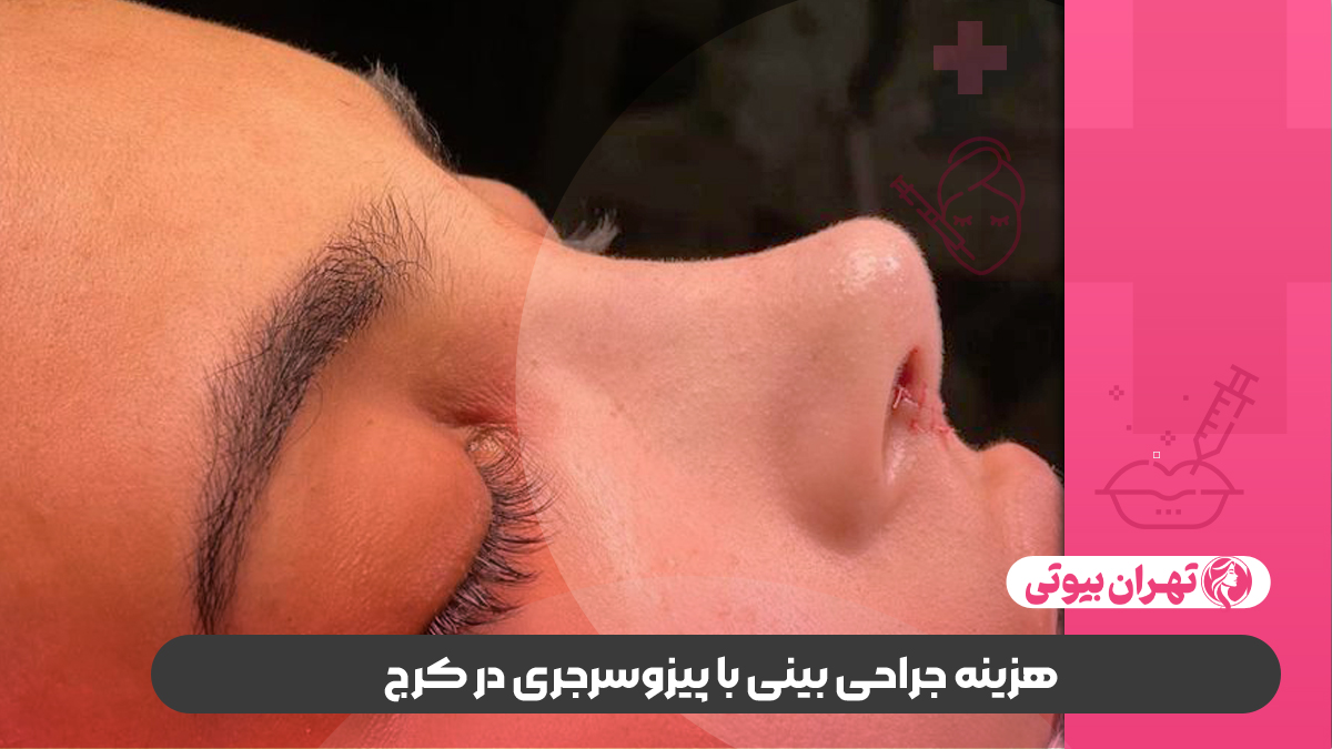 10 بهترین دکتر جراحی بینی با پیزوسرجری در کرج