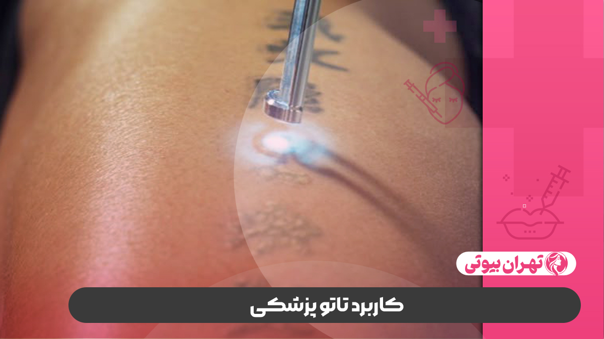 10 بهترین مرکز تاتو پزشکی در کرج