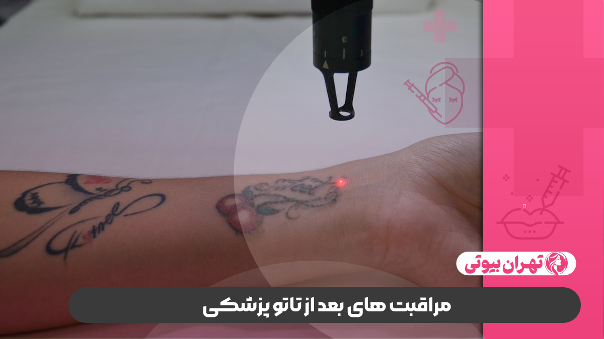 10 بهترین مرکز تاتو پزشکی در تهران