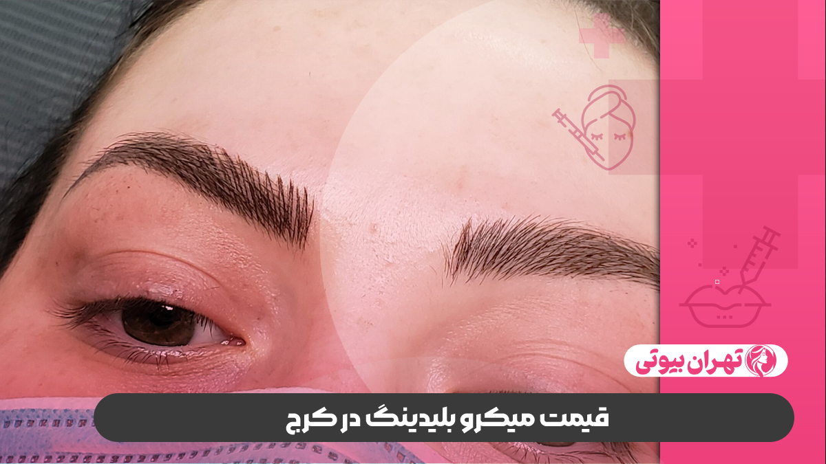 10 تا از بهترین مرکز میکروبلیدینگ در کرج