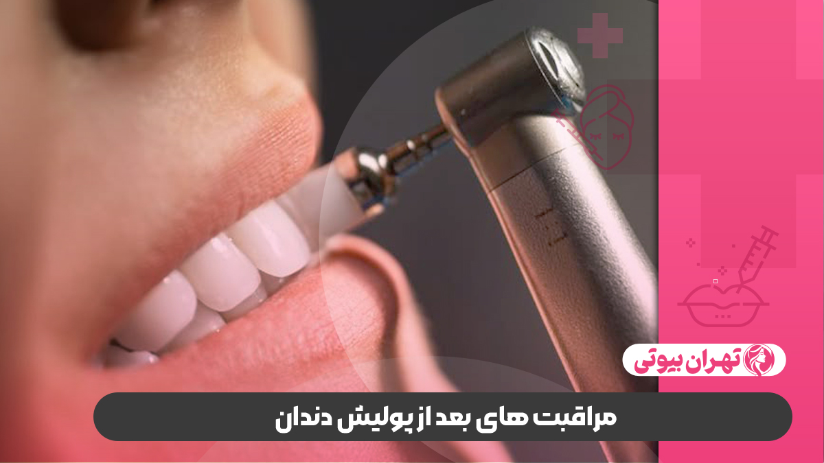 10 بهترین دکتر پولیش دندان در کرج