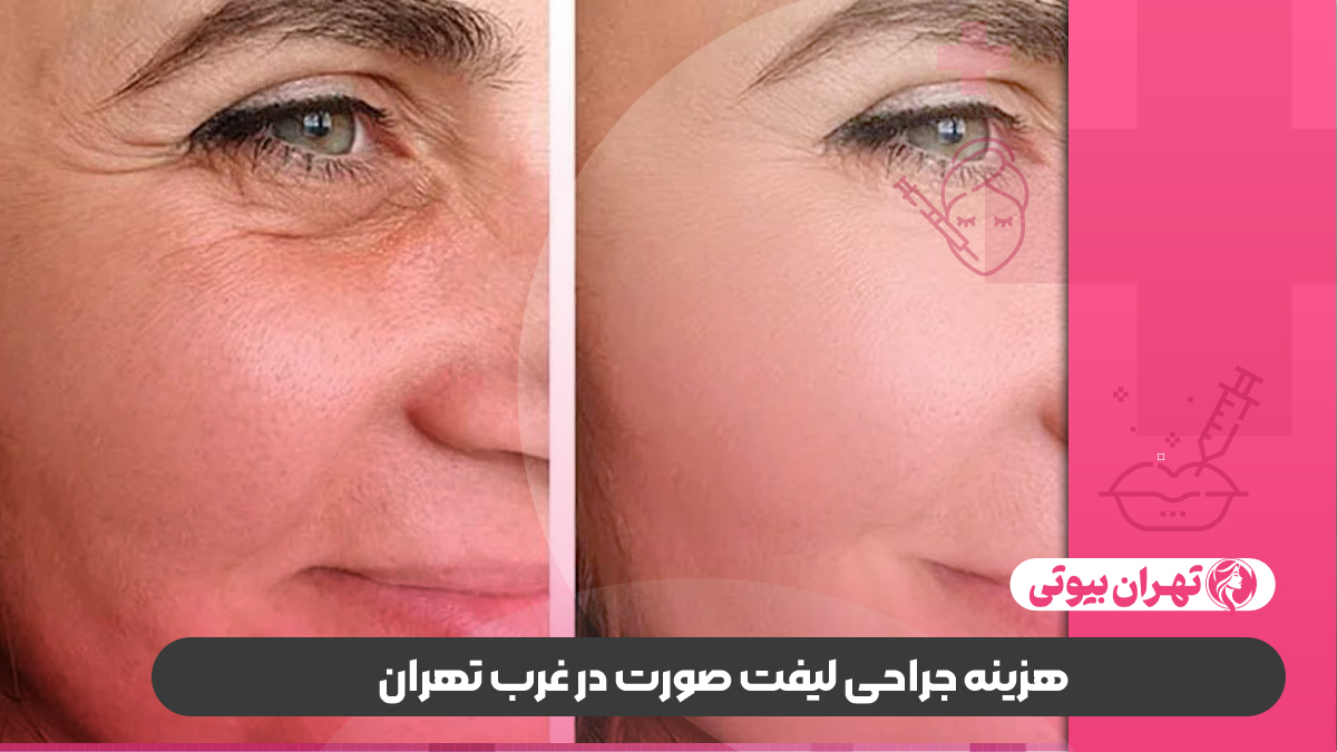 بهترین دکتر لیفت صورت در غرب تهران