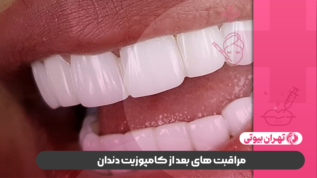 مراقبت های بعد از کامپوزیت دندان
