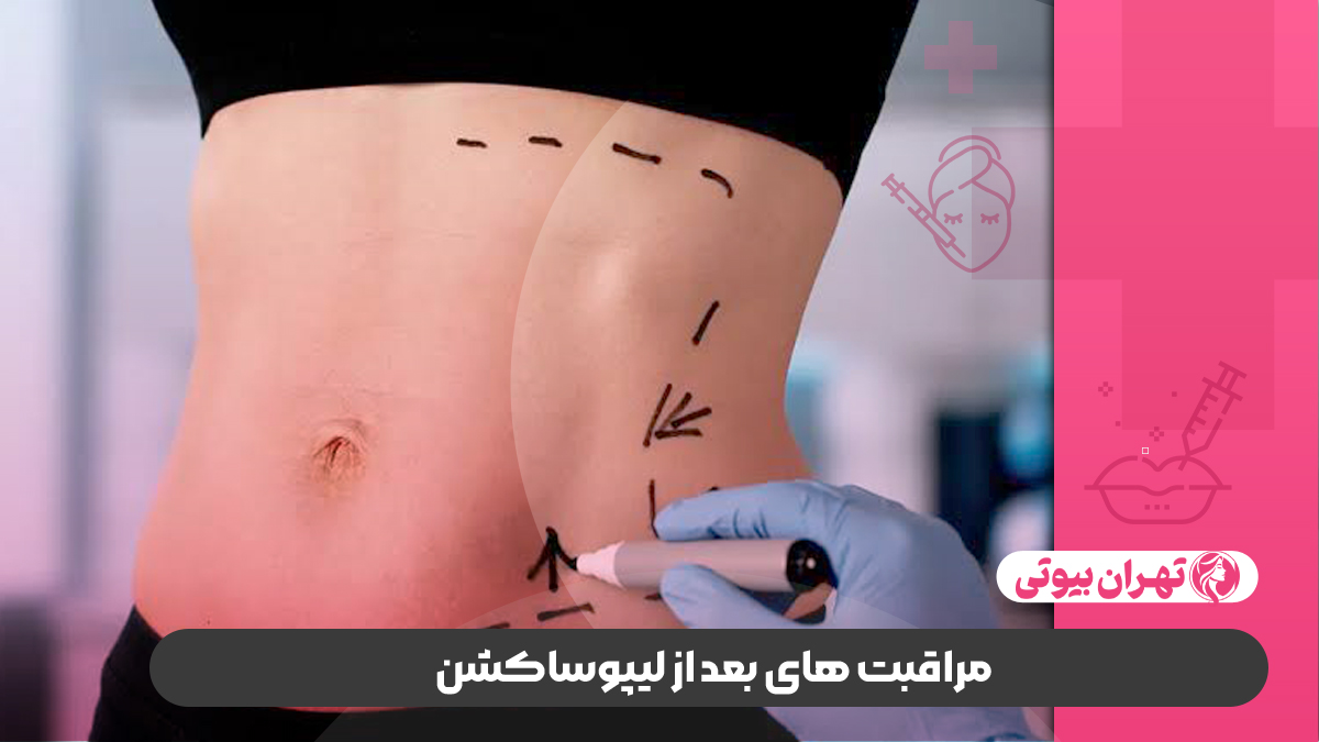 10 بهترین دکتر لیپوساکشن در شیراز