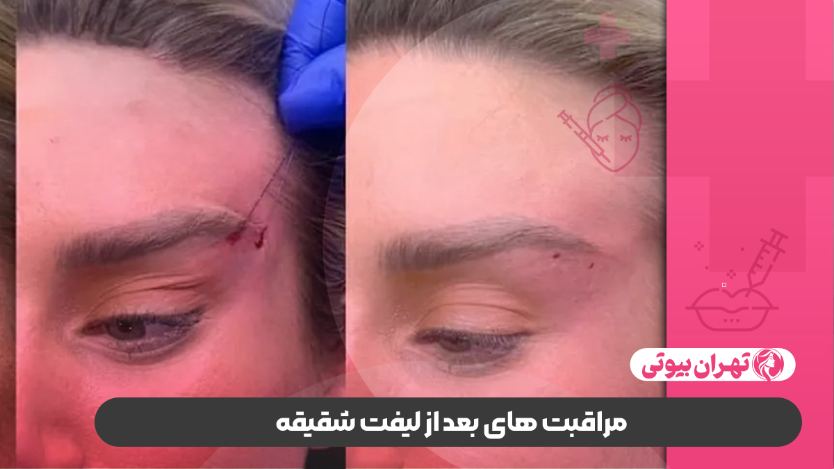 بهترین دکتر لیفت شقیقه در غرب تهران