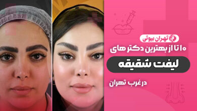 بهترین دکتر لیفت شقیقه در غرب تهران