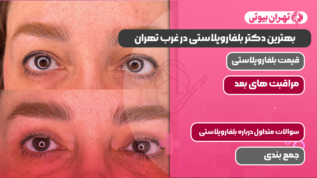 بهترین دکتر بلفاروپلاستی در غرب تهران