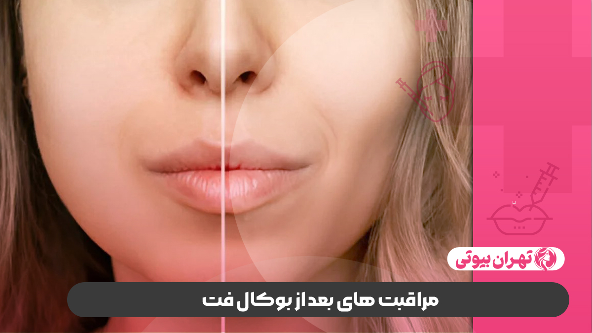 بهترین دکتر بوکال فت در غرب تهران