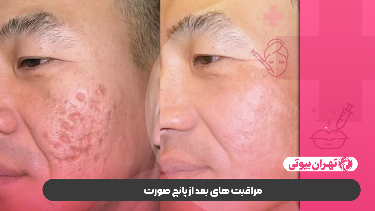 بهترین مرکز پانچ صورت در غرب تهران