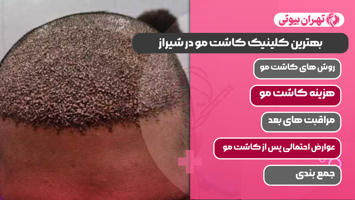 10 بهترین کلینیک کاشت مو در شیراز