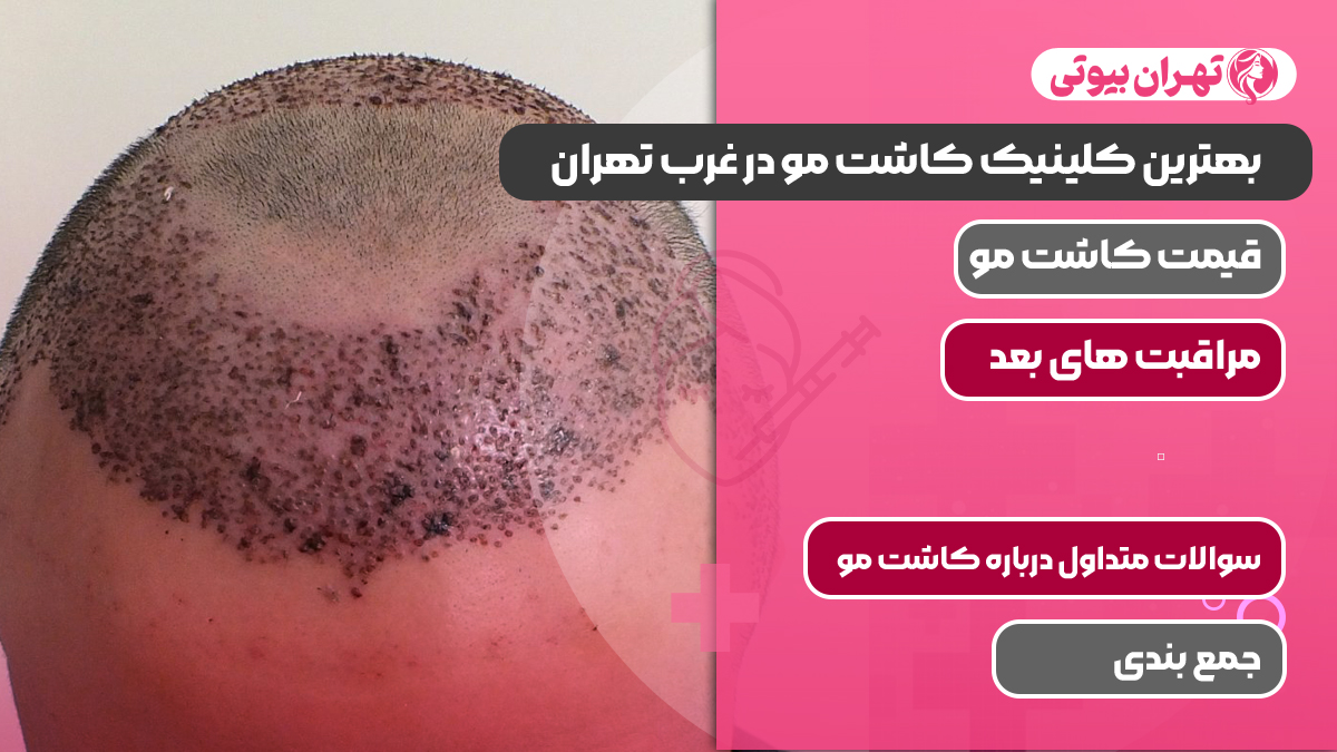 بهترین کلینیک کاشت مو در غرب تهران