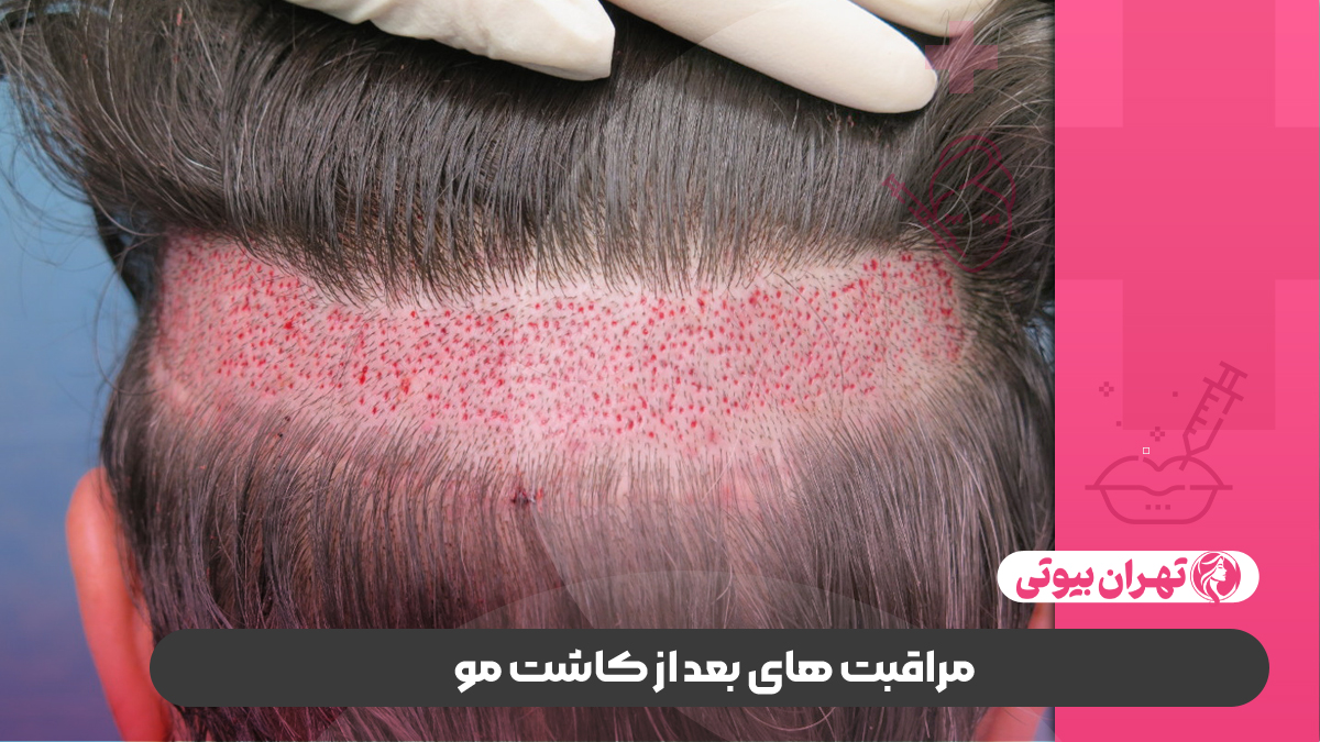 بهترین کلینیک کاشت مو در غرب تهران