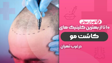 بهترین کلینیک کاشت مو در غرب تهران