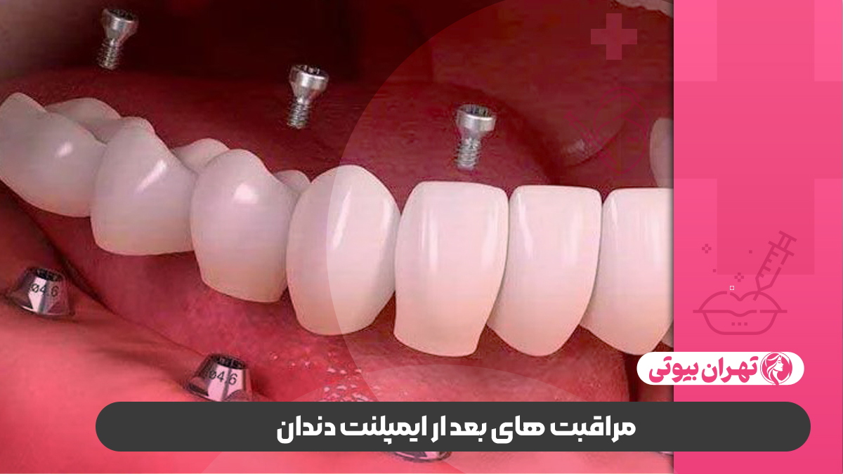 بهترین متخصص ایمپلنت دندان در غرب تهران