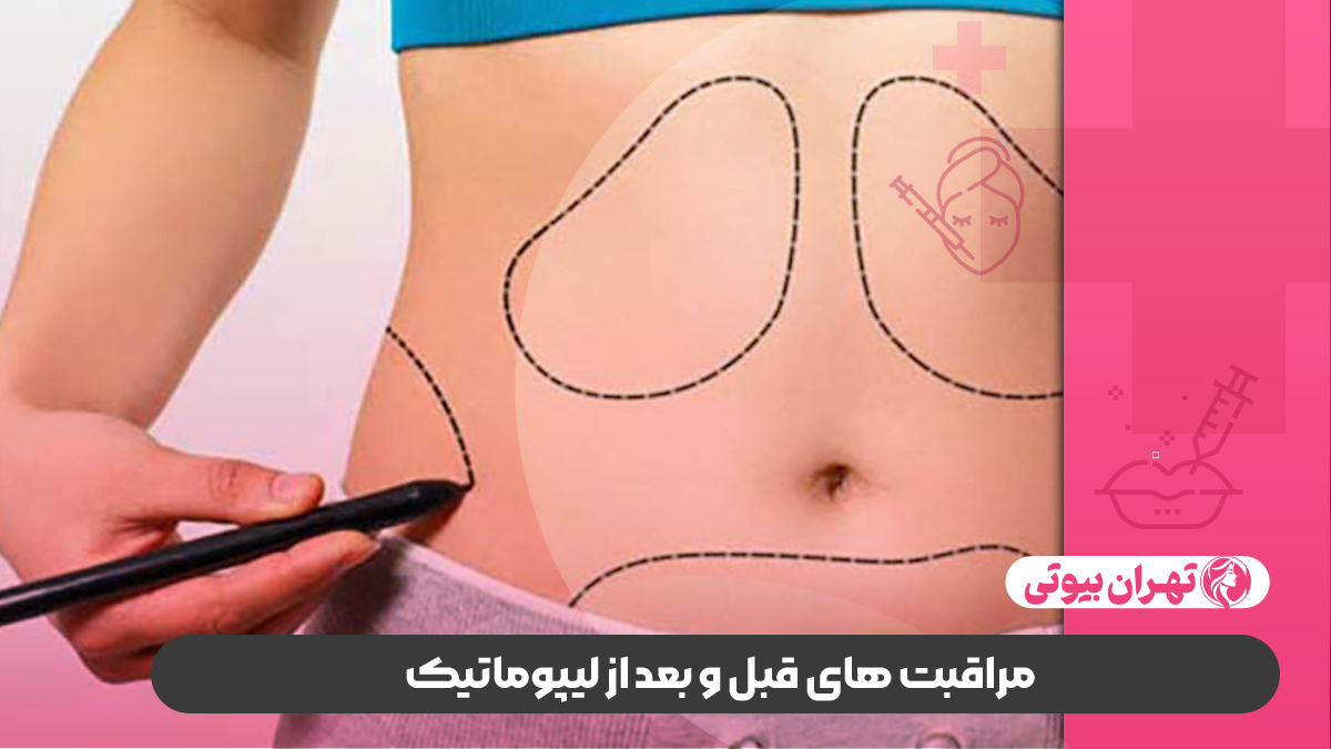 بهترین جراح لیپوماتیک در غرب تهران