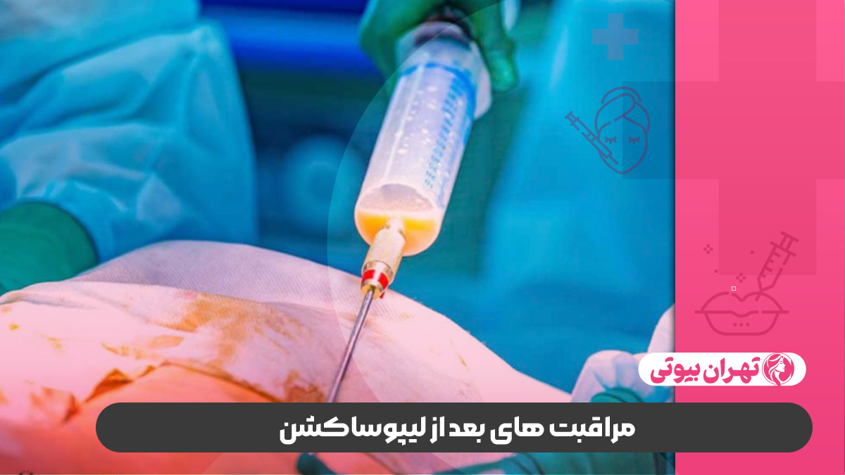 بهترین دکتر لیپوساکشن در غرب تهران