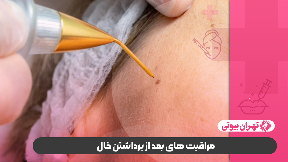 بهترین دکتر برداشتن خال در غرب تهران