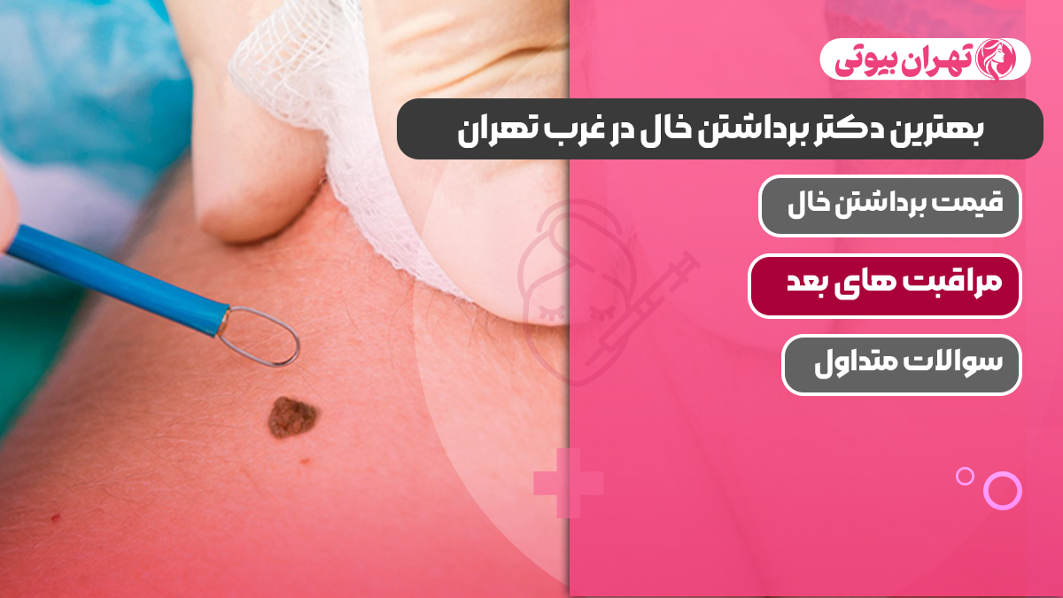 بهترین دکتر برداشتن خال در غرب تهران