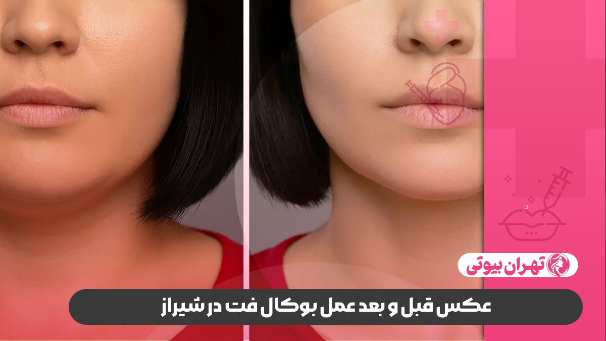 10 بهترین دکتر عمل بوکال فت در شیراز