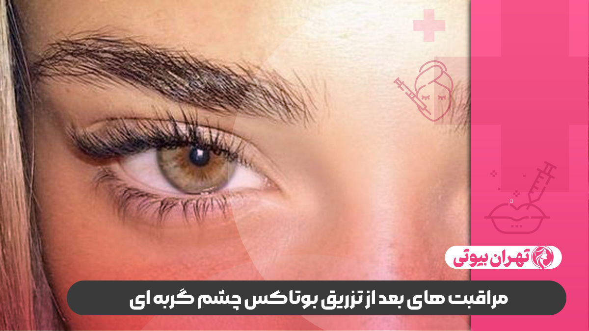 10 بهترین دکتر تزریق بوتاکس چشم گربه ای در شیراز