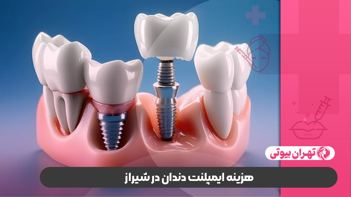 10 بهترین متخصص ایمپلنت دندان در شیراز