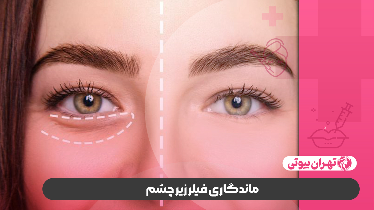 10 بهترین دکتر تزریق فیلر زیر چشم در شیراز